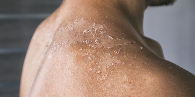 5 Effective Ways to Deal with Peeling Skin