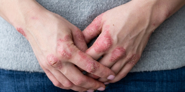 Itchy and Annoying, Here are 5 Ways to Treat Skin Rashes with Natural Ingredients