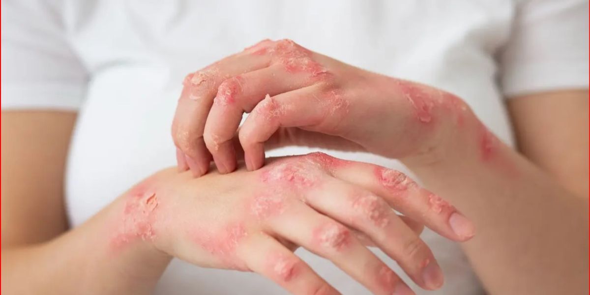 Early Symptoms of Kidney Disease Visible on the Skin, Do Not Ignore