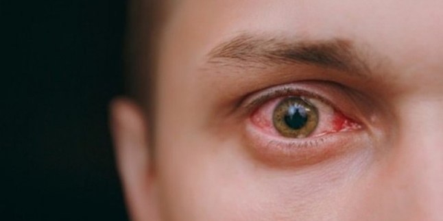 Irritation - Reddish, Here are 6 Natural and Easy Ways to Treat Eye Pain