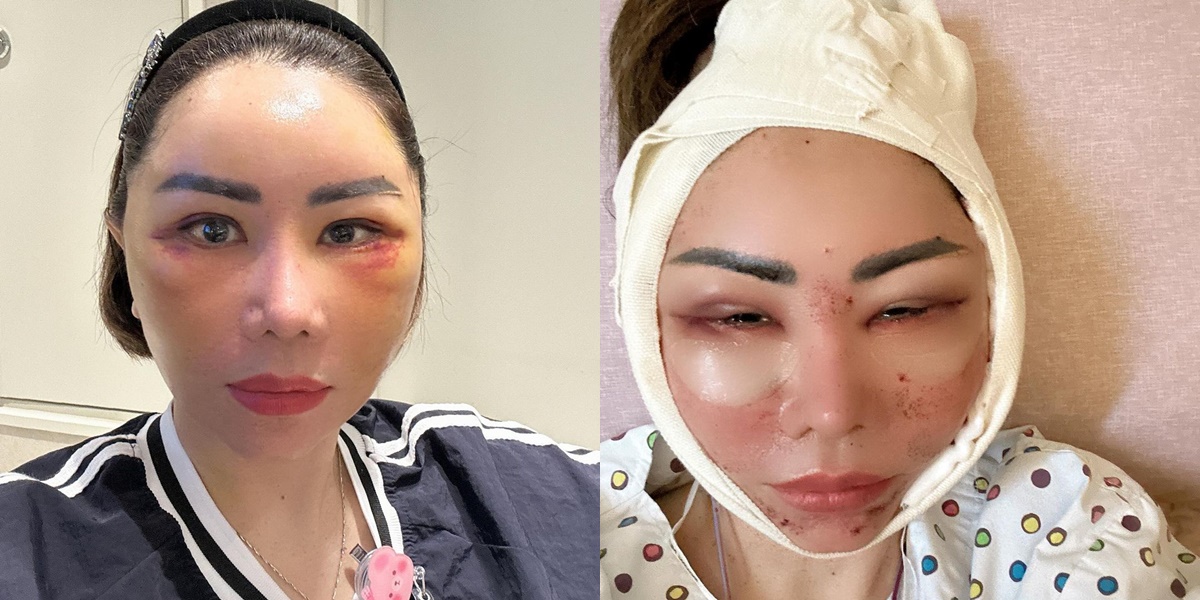 Undergo Plastic Surgery Again, Here are 7 Photos of Femmy Permatasari Showing a Face Full of Bruises and Swelling