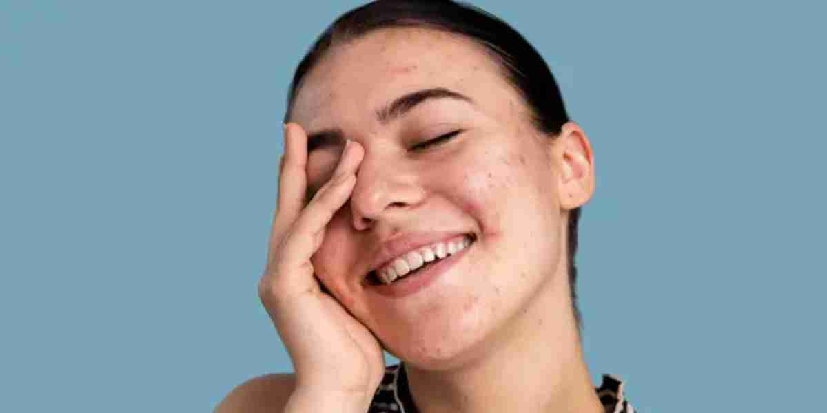 Acne Gone Without Skincare? Here are 9 Natural Ways to Try