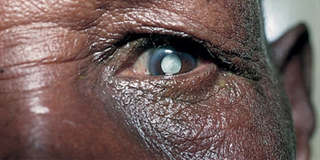 Know as Early as Possible, 7 Causes of Cataracts and How to Prevent Them