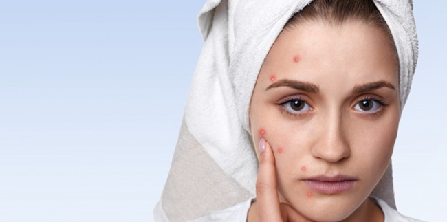 Know 8 Foods that Cause Acne on the Skin, One of Which is High in Sugar