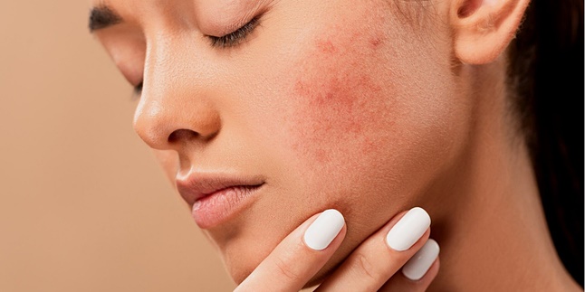 Often Done, Here are 7 Bad Effects of Popping Pimples