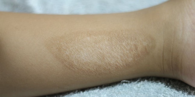 To Return Smooth, Here are 7 Ways to Naturally Remove Exhaust Burn Scars