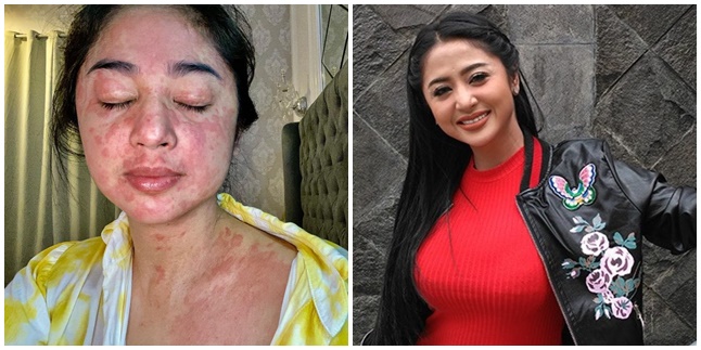 Related to the Severe Allergy She Experienced When Contracting Covid, Dewi Perssik: 90% Rare