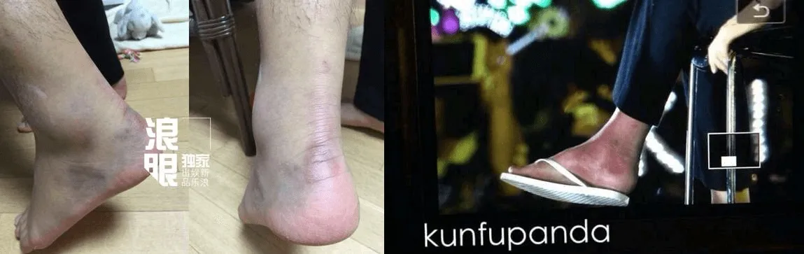 Foto kaki Tao yang cedera beredar secara online di media China © Sina via Koreaboo.com