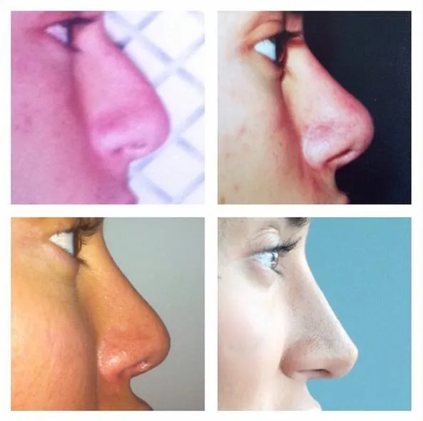 Transformasi hidung Justin @ instagram.com/justinjedlica