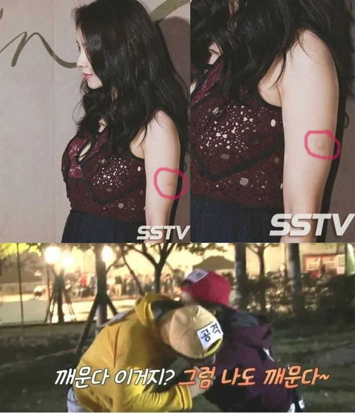 Lengan Ji Hyo yang ternyata terluka karena digigit Lee Kwang Soo. ©koreaboo.com