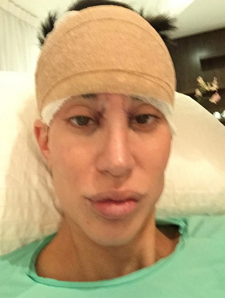 Beberapa hari lalu Justin juga menjalani operasi dahi @ Instagram/Justin Jedlica