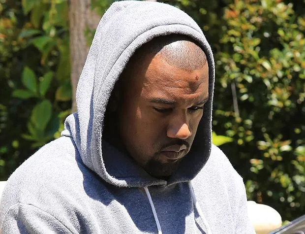 Benjolan di dahi Kanye West @ thesun.co.uk