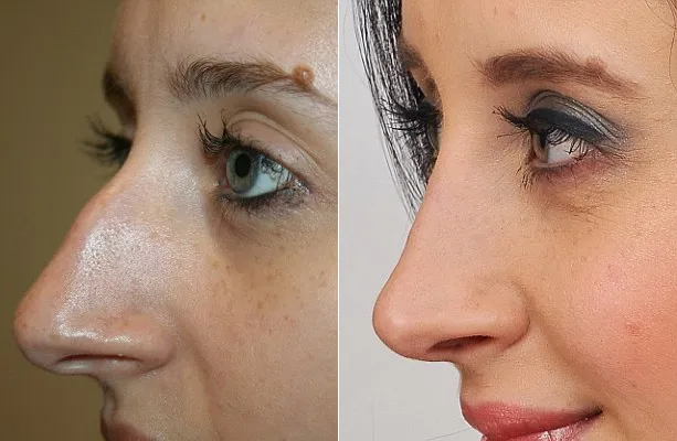 Salah satu wanita yang mengubah bentuk hidungnya @ dailymail.co.uk