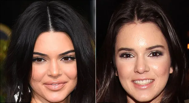 Transformasi bibir Kendall dulu dan kini © istimewa