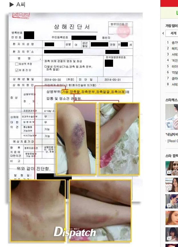 Luka-luka yang diderita A karena ulah Kim Hyun Joong?