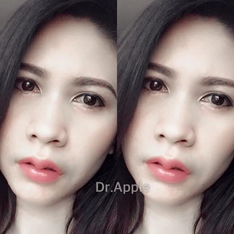 Dibutuhkan dana Rp 11-21 juta untuk setiap prosedur operasi Krachap Lips © odditycentral.com