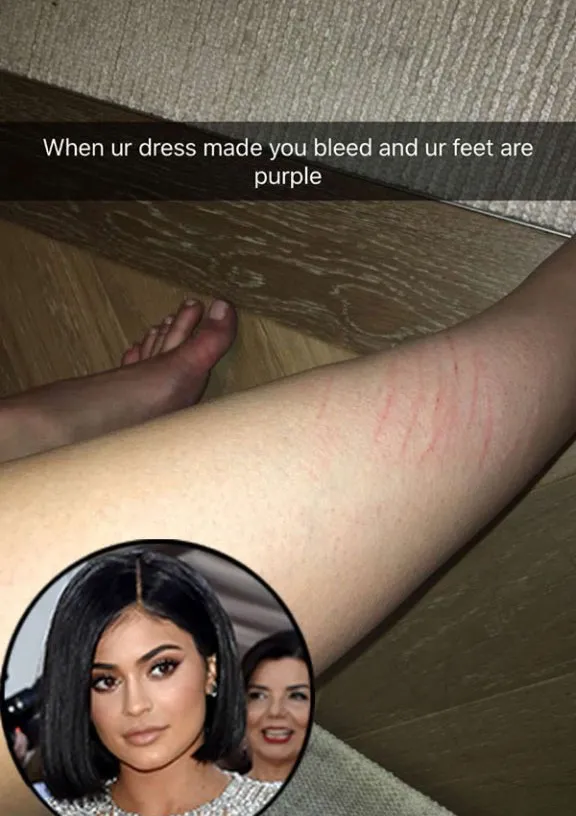 Kaki Kylie Jenner jadi lecet gara-gra gaun di Met Gala © Hollywoodlife.com