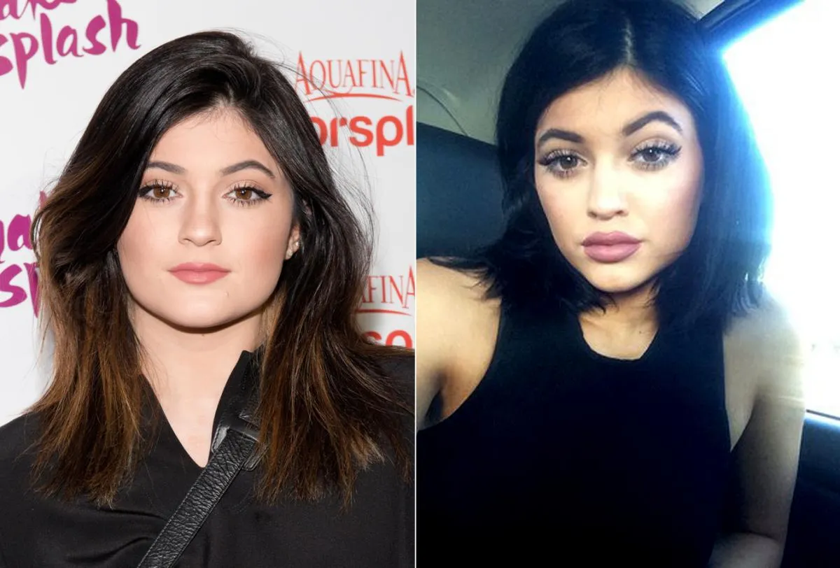 Perubahan wajah Kylie Jenner © nydailynews.com