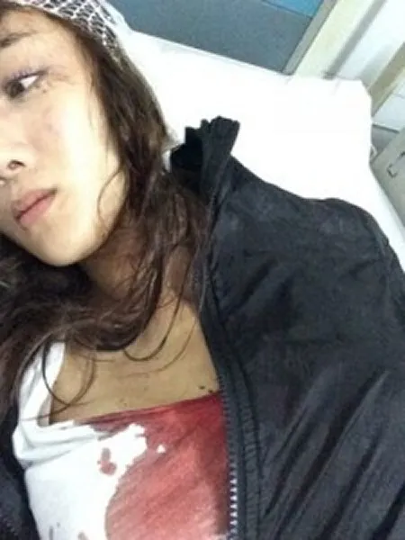 Foto Li Yixiao yang terluka akibat serangan anjing Alaska Michelle Ye. ©lollipop.sg 