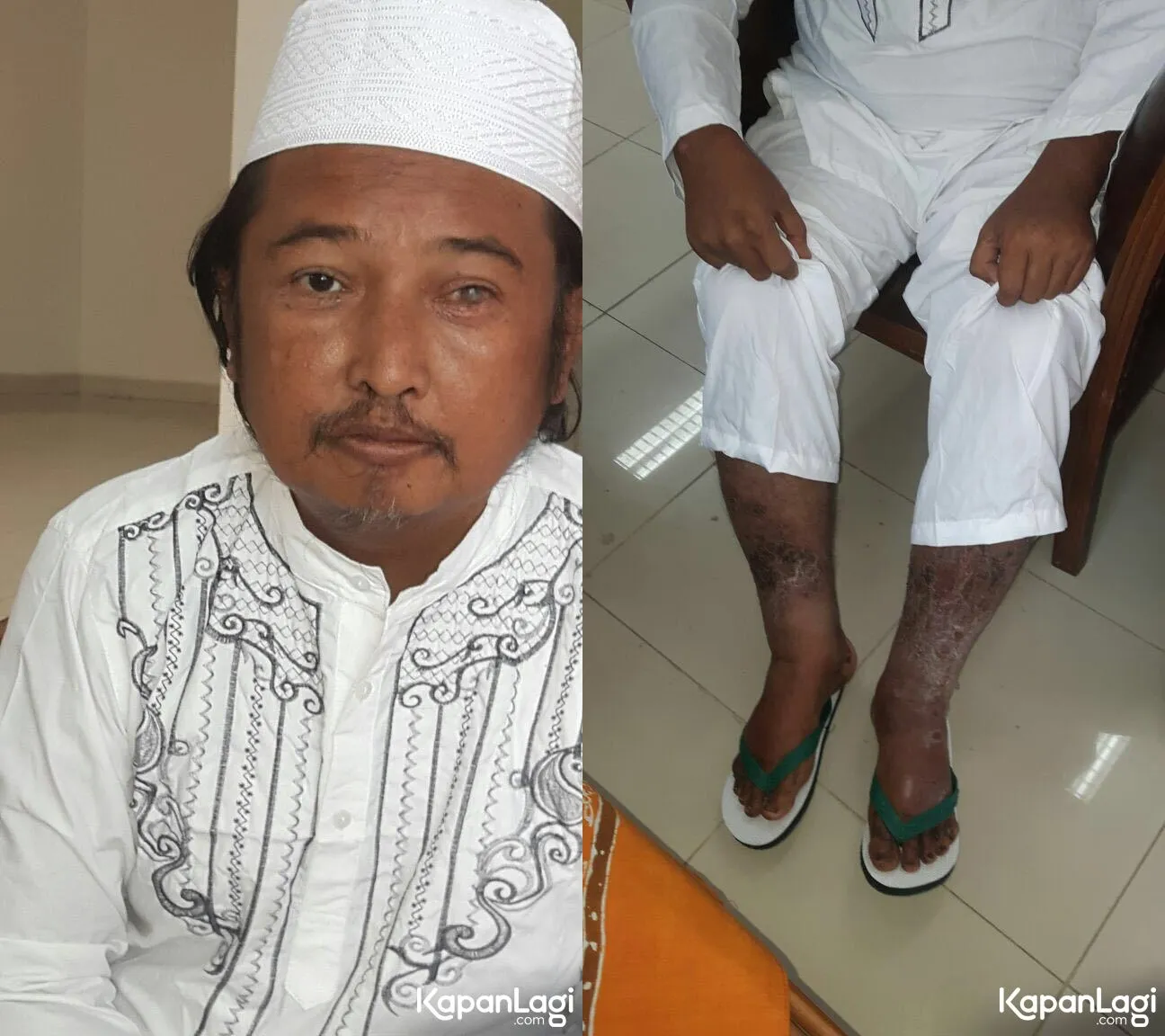 Kondisi miris ayah Marshanda, matanya memutih dan kakinya terluka. ©petugas Dinas Sosial