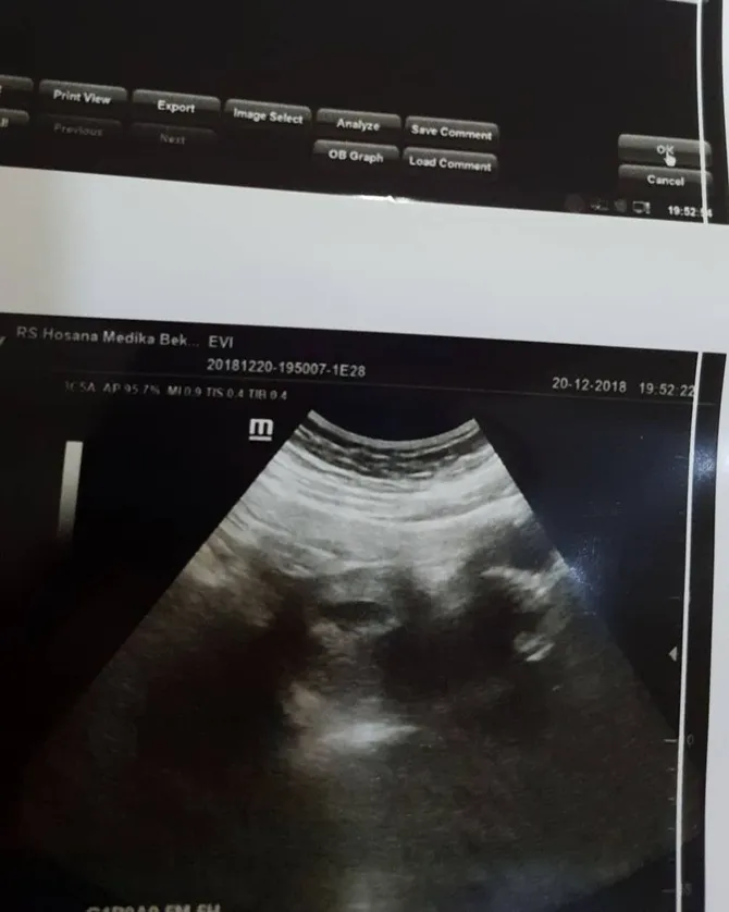 hasil USG Evi Masamba (credit: instagram.com/evi_masamba_real)