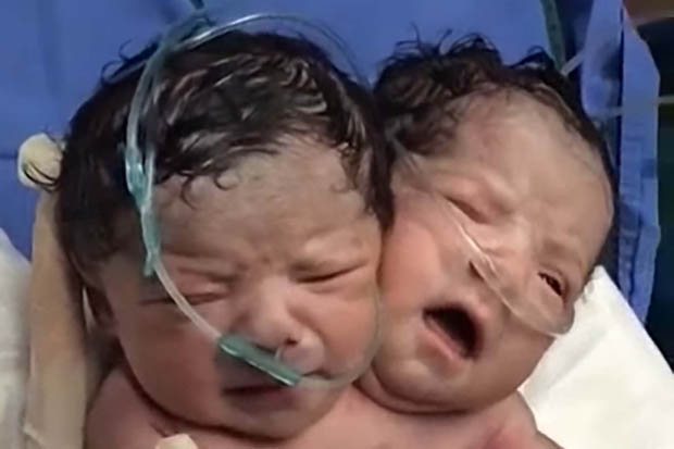 Bayi berkepala dua asal Meksiko ini  hanya hidup sehari © dailystar.co.uk