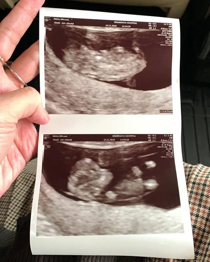 Hasil USG Kandungan Nikita Mirzani ©instagram/Nikitamirzanimawardi_17