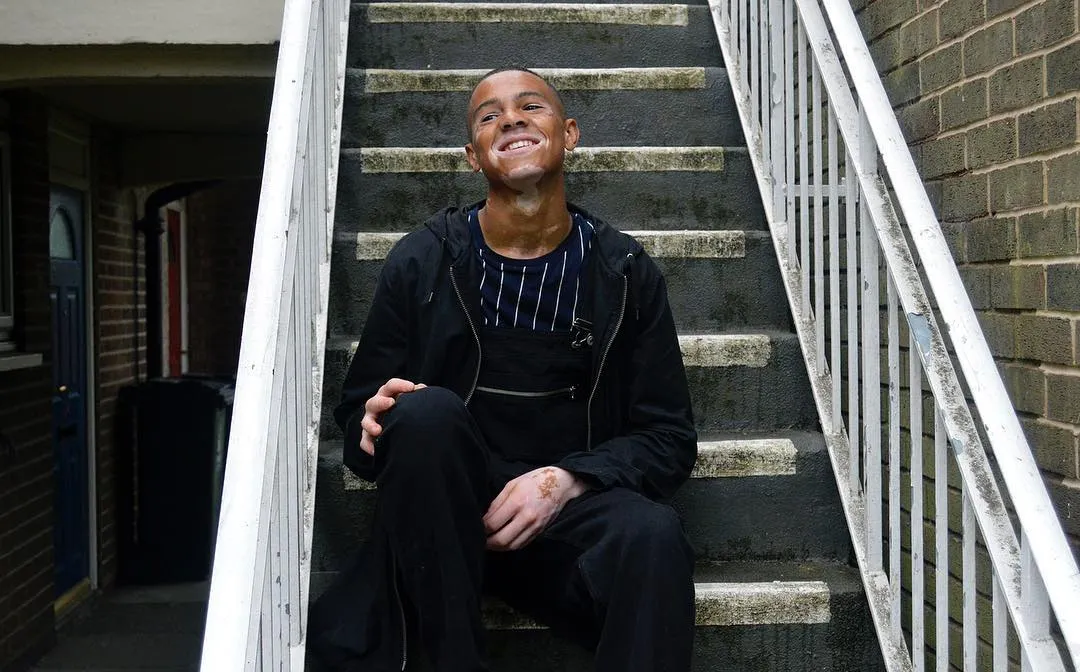 Nile Goodlad, sempat merasa 'down' karena kondisi kulitnya yang berbeda dari orang kebanyakan © instagram.com/nilegoodlad