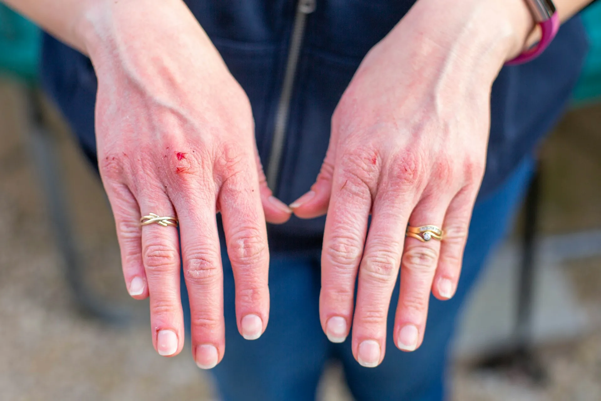Potret kulit tangan iritasi (credit: Unsplash)