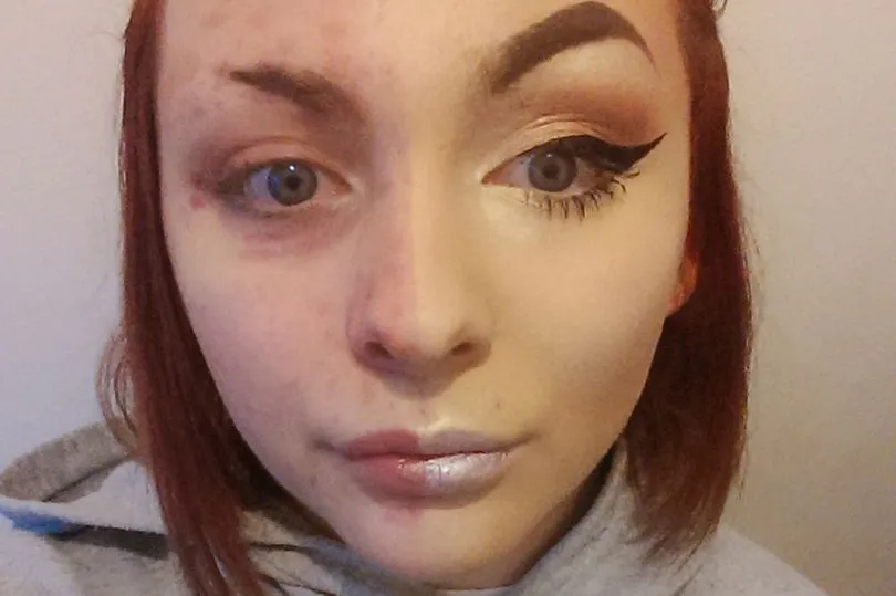 Seorang gadis Inggris diputuskan pacarnya begitu menghapus make up karena menderita psoriasis © Mirror.co.uk