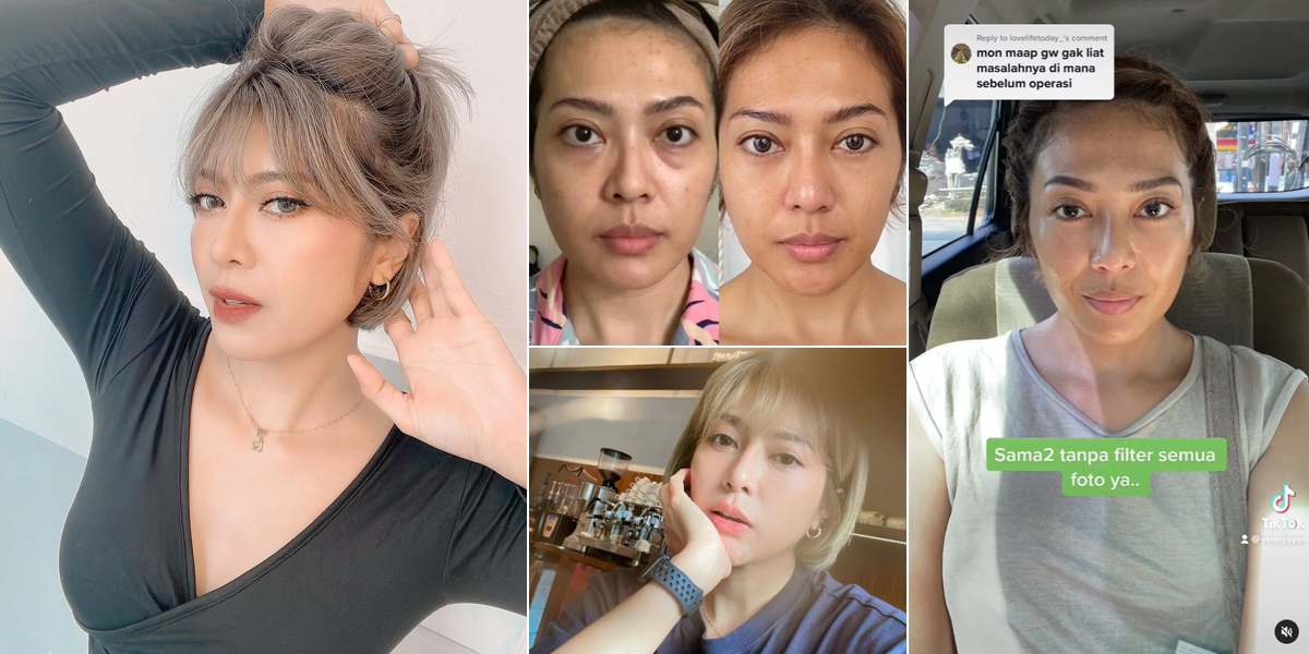 10 Photos of Yenny AFI's Transformation Who Honestly Admits Nose Surgery, Getting More Beautiful & Glow Up