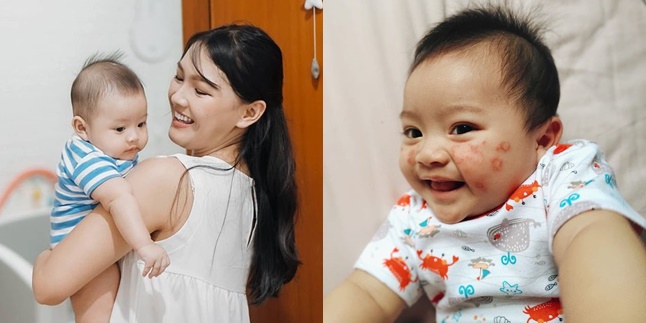 8 Portraits of Ana Riana's 'Motorcycle Taxi Driver' Child Experiencing Skin Disorders Until Bleeding, Blamed by Netizens Because of Breast Milk