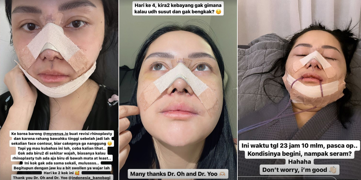 9 Photos of Mawar AFI's Plastic Surgery in Korea, Replacing Nose Implants that Have Been There for 12 Years - Swollen Face Without Bruises Becomes the Highlight