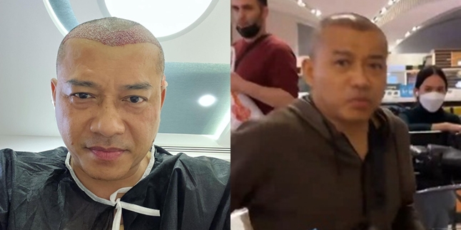 Distracting Attention, Here are 8 Latest Photos of Anang Hermansyah After Hair Transplant in Turkey - Even Said to Resemble Raul Lemos