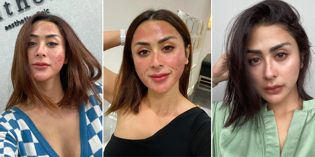 For Glowing and Shiny, Take a Look at 8 Photos of Selvi Kitty Willing to Undergo Beauty Treatments Until Her Face Turns Red