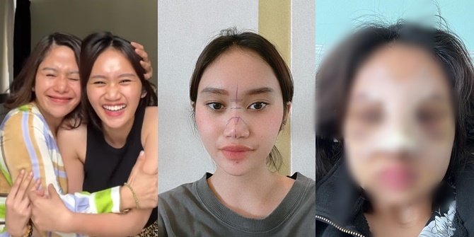 Photo of Dhyaz, Farida Nurhan's Child, After Plastic Surgery, Swollen and Bruised Face Makes Netizens Curious About the Results