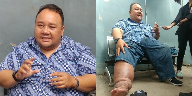 Swollen Leg Photos of Rony Dozer Allegedly Affected by Black Magic During Shooting, Having Difficulty Urinating - Is There a Snake in His Stomach?