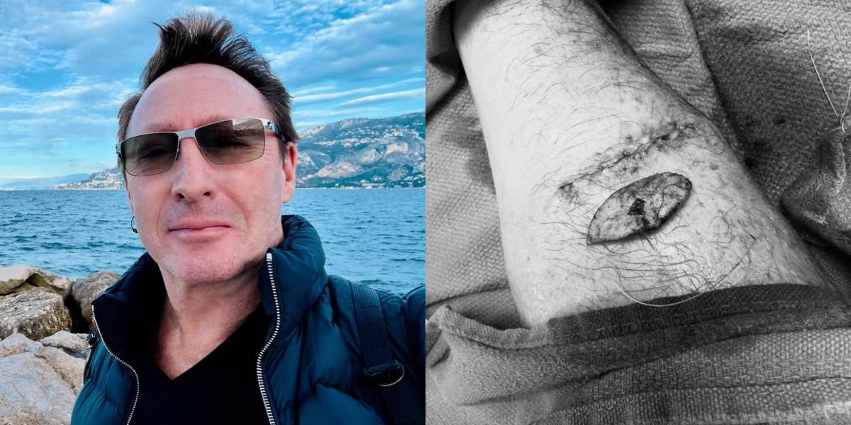 Julian, Son of John Lennon, Reveals He Has Skin Cancer, Here's His Condition