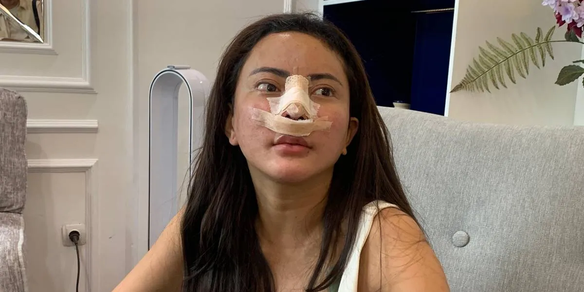 Portrait of Ayu Aulia's 8th Nose Job, Choosing to Use Rib Bone for More Durability