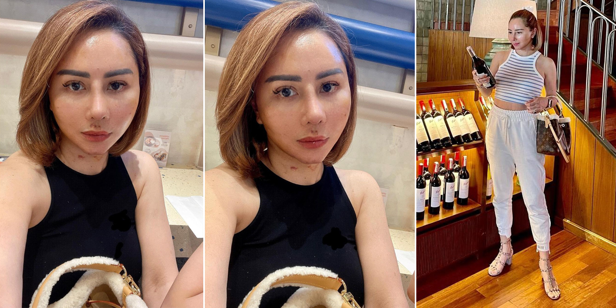 Latest Portraits of Femmy Permatasari After Nose Plastic Surgery in Korea, Her Face Looks Different - Netizens Say She Resembles Denise Chariesta