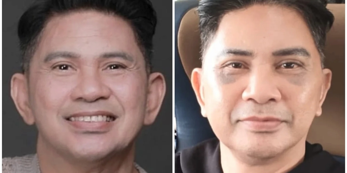 The Transformation Portrait of Ronny Sianturi Who Just Underwent Facial Surgery at Age 60, Looks Fresher