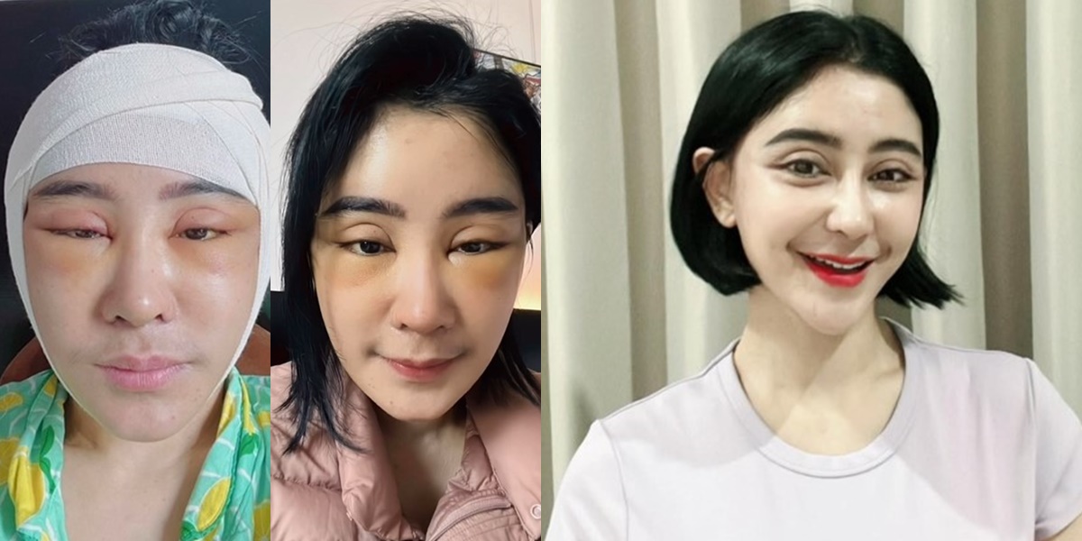 Portrait of Uut Permatasari's Transformation After Plastic Surgery in Korea, Feels Younger