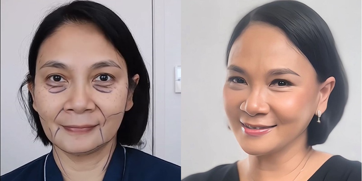 Portrait of Dian Nitami's Face After a Month of Face Lifting Surgery, Satisfied Her Skin Feels Tight and the Result is Natural