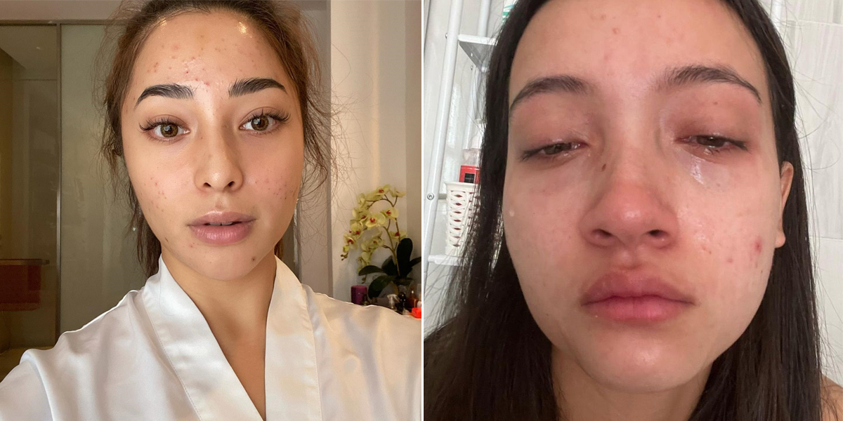 From Lesti to Nikita Willy, These 10 Beautiful Artists Remain Confident Showing Their Acne-Filled Faces