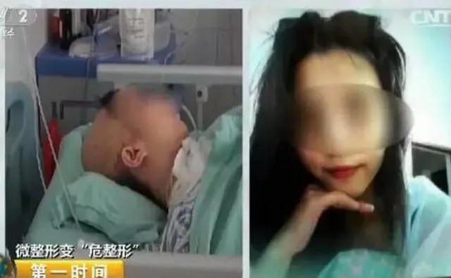 Dokter klinik salah menyuntikkan lemak di bagian pelipis sehingga menyerang otak dan menyebabkan kelumpuhan © Shanghaiist.com