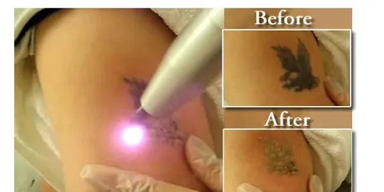 Menggunakan Laser (c)indianatattooremoval.com