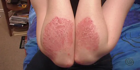 Psoriasis yang bisa disembuhkan oleh kulit pisang (c)www.sich.co.uk