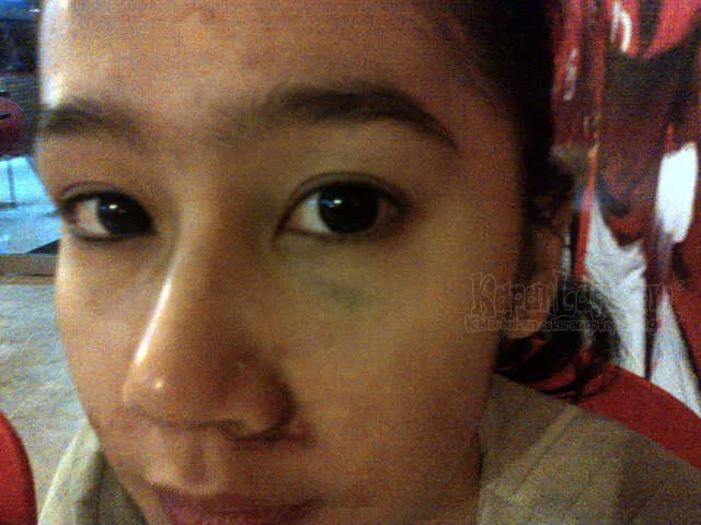 Mata Ardina Rasti lebam setelah dipukul Foto: Dokumentasi Pribadi