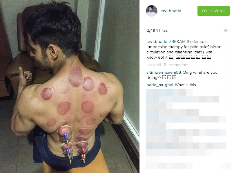 Ravi coba terapi bekam ©instagram/ravi.bhatia