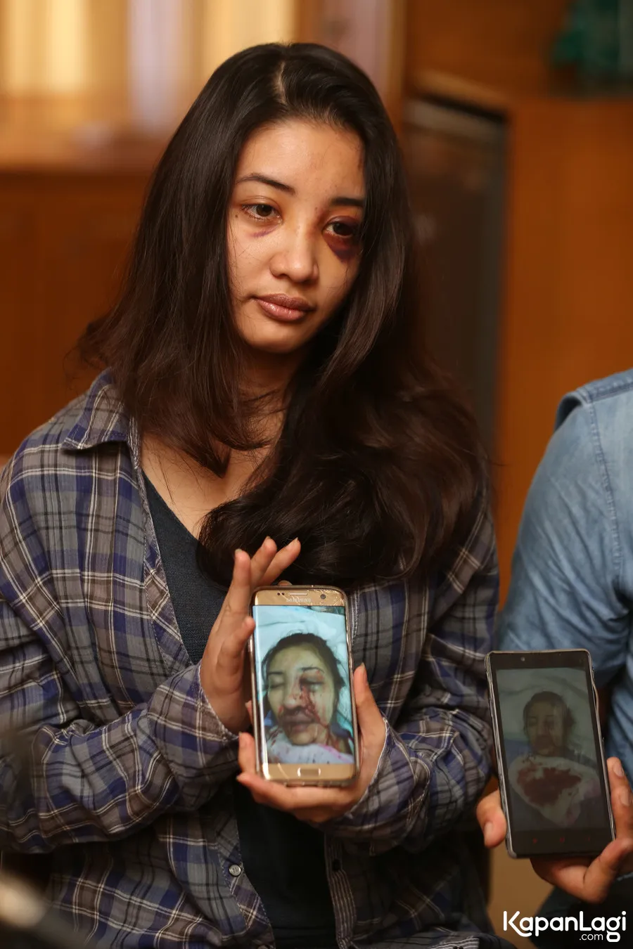 Wajah Saori Ishii sempat berdarah-darah akibat aksi pemukulan mantan pacarnya. ©KapanLagi.com/Budy Santoso